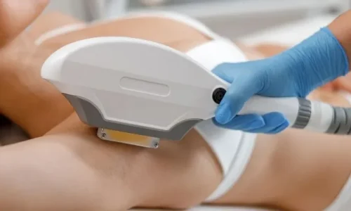 IPL Epilasyon Nedir?